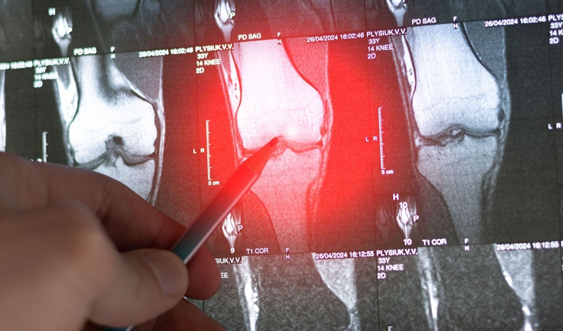 AI-powered digital twins set to revolutionize bone metastasis research